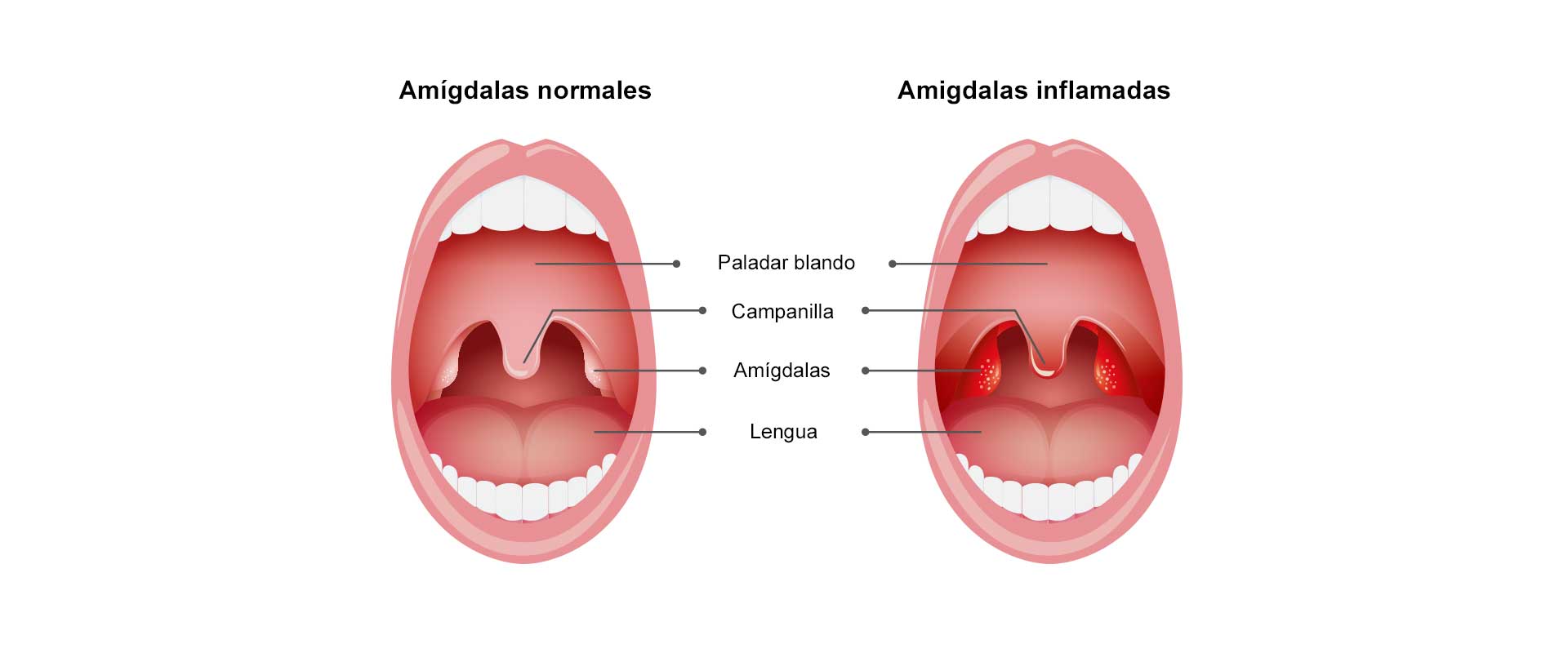 Infografia de 2 gargantas, una sana y otra con amigdalas inflamadas