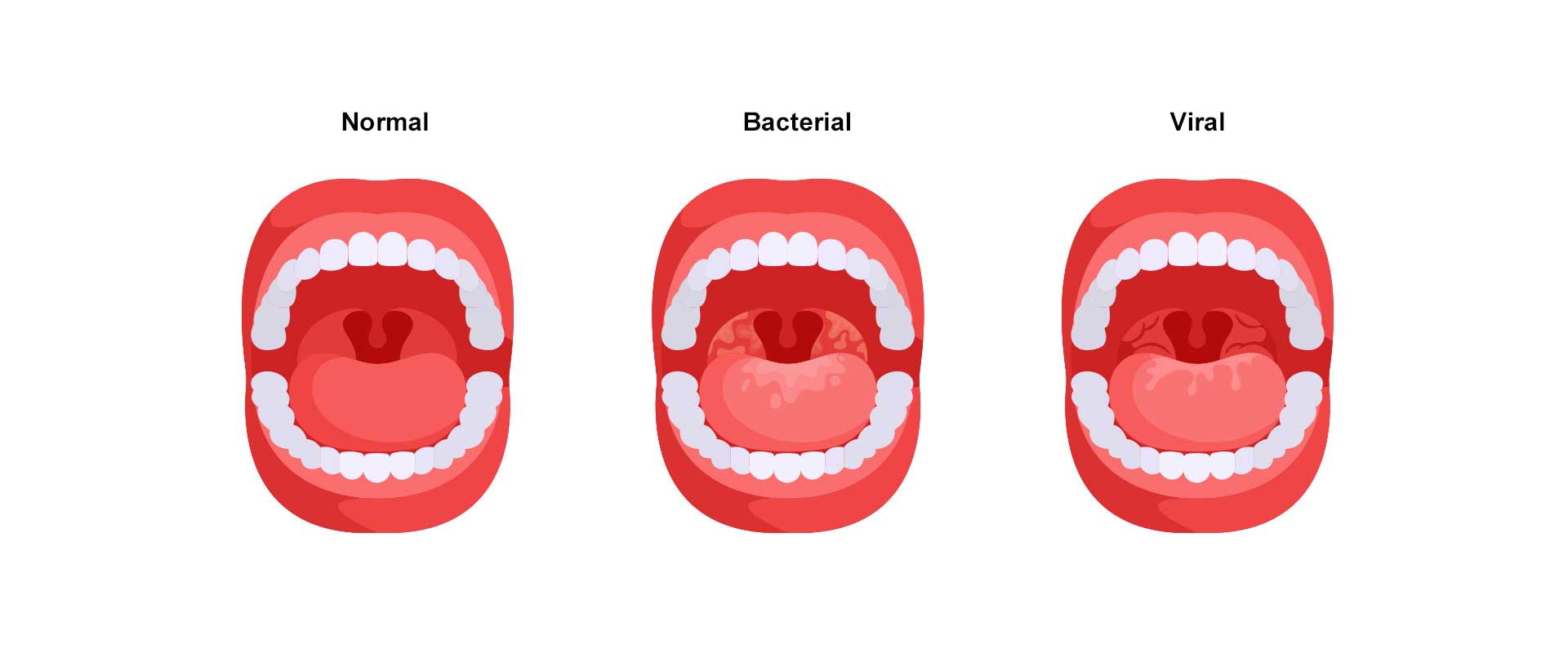 Infografía mostrando cómo luce una garganta sana, una con infección bacterial y otra con un cuadro viral