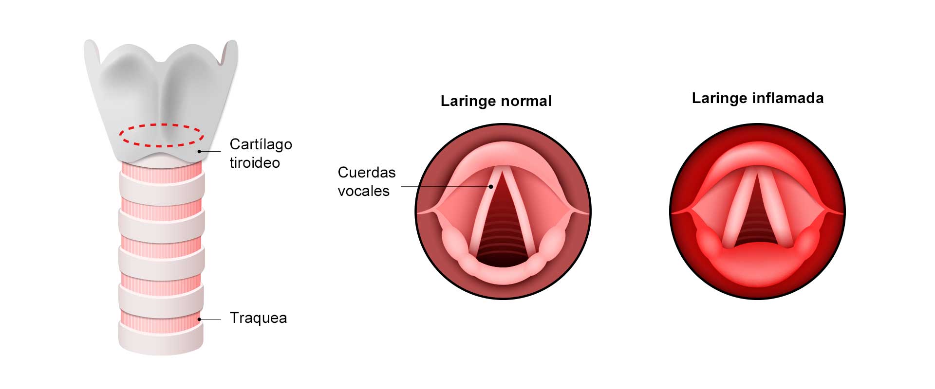 Infografía que muestra la como es la inflamacion de las cuerdas vocales